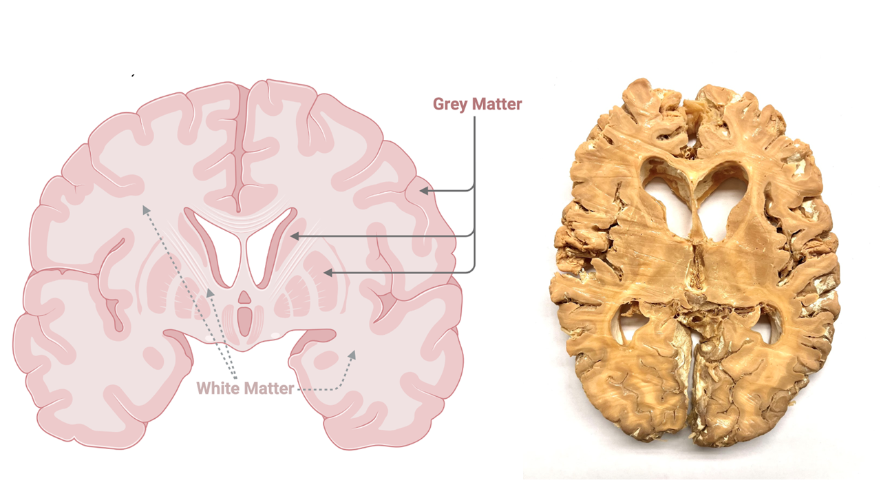 A diagram on the left side of the image shows a coronal cross section of the human brain. Labeled arrows identify the white matter colored pale pink generally located on the inside of the brain and the gray matter colored darker pink, which forms the outer edges of the brain and some of the deep clusters within the brain. On the right side of the image is a photo of a preserved specimen of a similar cross section of a human brain. In the preserved specimen, the white matter is visible as a light tan color w