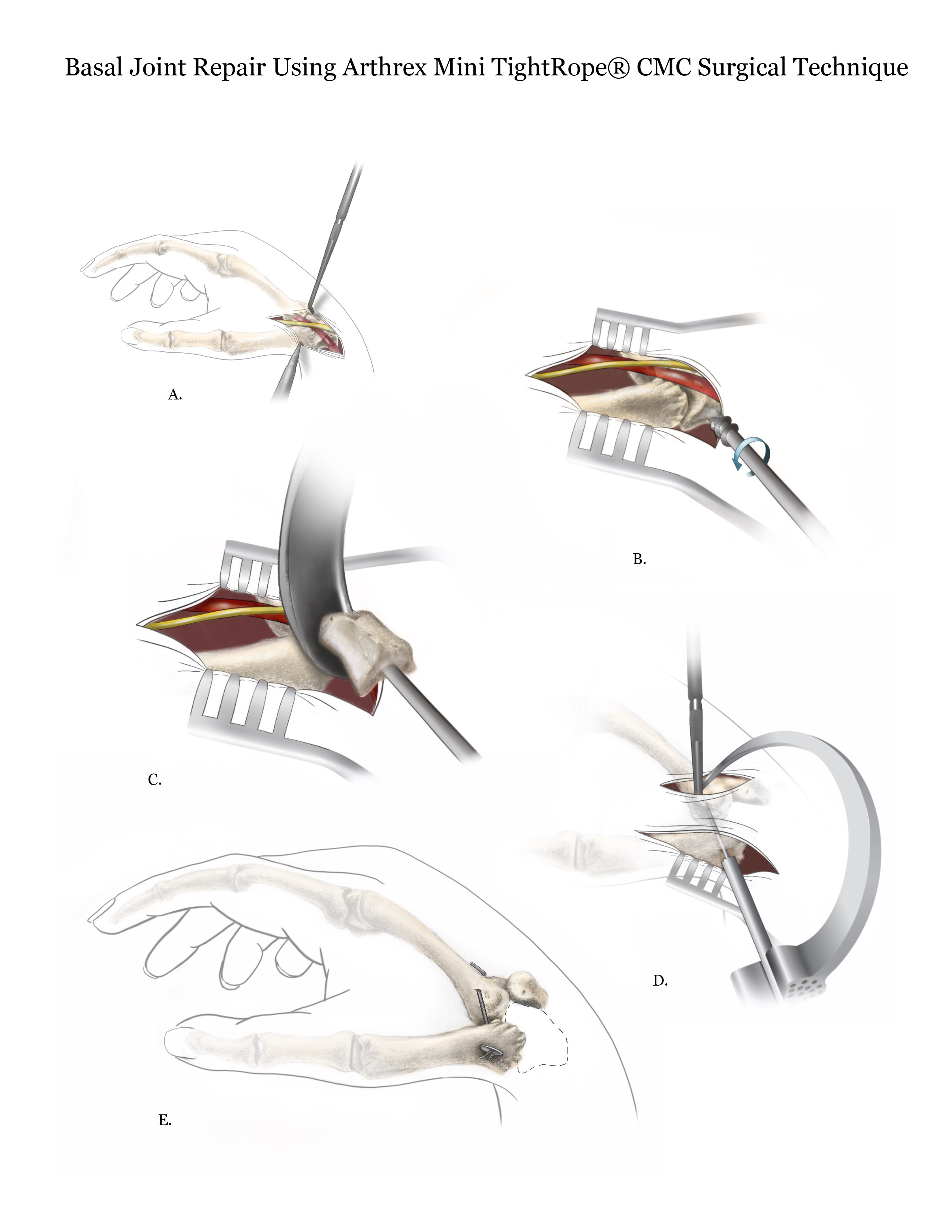 Illustration of the basal joint repair process by Julia Lunavictoria