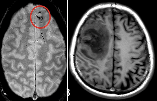 Two horizontal cross sections are shown, each of which features a region of damaged brain, appearing as an unusual dark section.