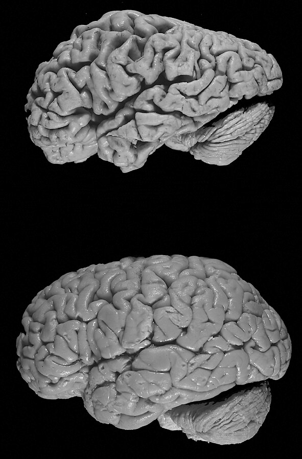The top brain with Alzheimer’s disease has severely shriveled gyri in its cerebral cortex and has an overall shrunken appearance in comparison to the healthy brain seen on the bottom.