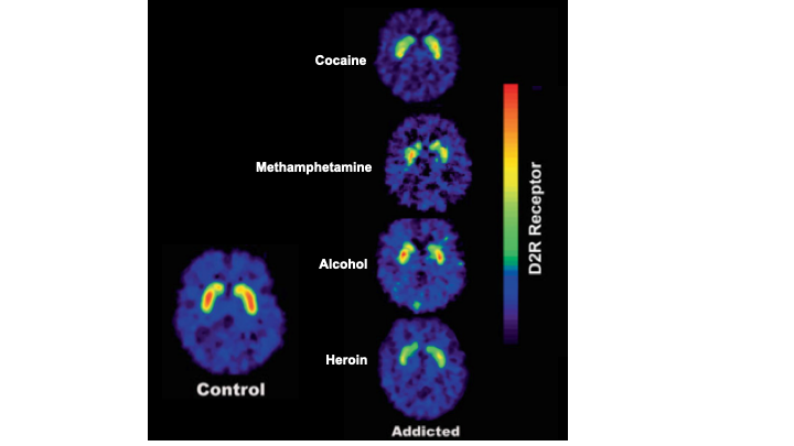 Five horizontal cross sections of the brain are shown, via PET imaging. For each, most of the brain appears blue with a low level of dopamine receptors being present. The brain marked Control shows yellow and red color in an area deep inside the brain, indicating a high level of dopamine receptors. In each of the other four brains (marked as addicted to cocaine, methamphetamine, alcohol, and heroin) that same deep brain regions is visible as having a warmer color indicating more dopamine receptors than the 