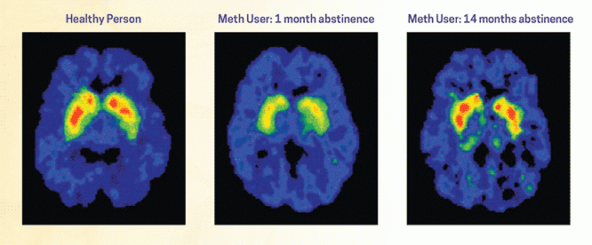 Three horizontal cross sections of the brain are shown, via PET imaging. For each, most of the brain appears blue with a low level of dopamine receptors being present. The brain marked Healthy Person shows yellow and red color in an area deep inside the brain, indicating a high level of dopamine receptors. The brain marked Meth User after one month of abstinence shows less red and yellow color in that brain region, implying fewer dopamine receptors. The brain marked Meth User after 14 months of abstinence s