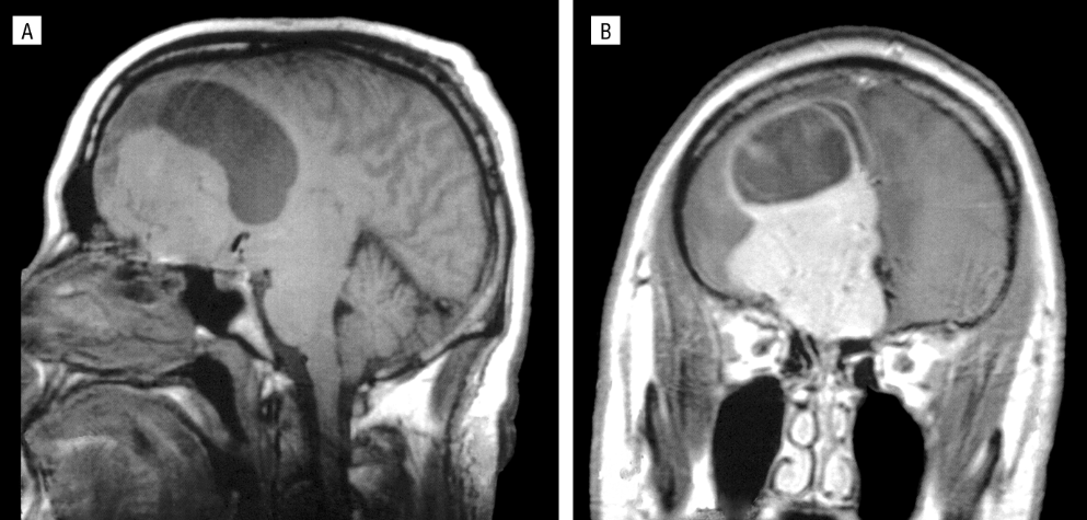 A midline sagittal cross section and a coronal cross section show the tumor in question covering a large portion of the prefrontal cortex.