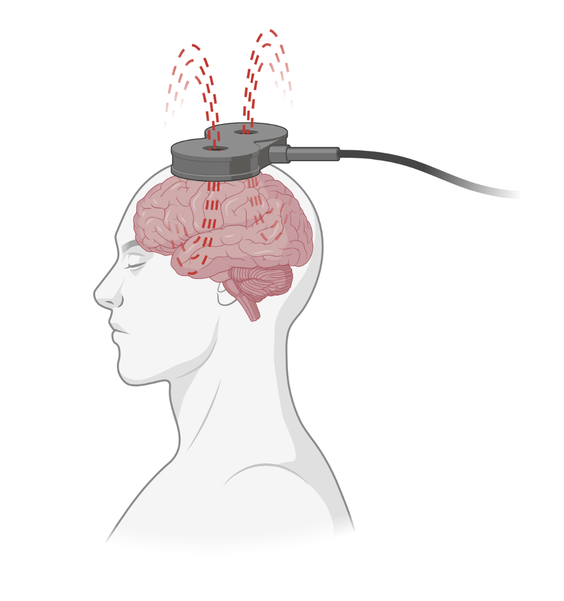 A TMS coil is shown with electrical current running through it, inducing a magnetic field in the brain region directly underneath it