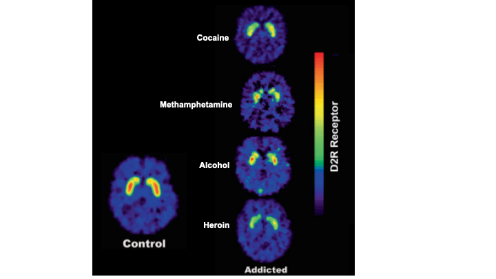 Five horizontal cross sections of the brain are shown, via PET imaging. For each, most of the brain appears blue with a low level of dopamine receptors being present. The brain marked Control shows yellow and red color in an area deep inside the brain, indicating a high level of dopamine receptors. In each of the other four brains (marked as addicted to cocaine, methamphetamine, alcohol, and heroin) that same deep brain regions is visible as having a warmer color indicating more dopamine receptors than the